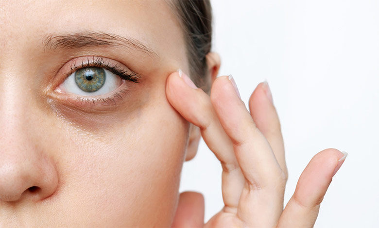 علت و روش رفع و درمان سیاهی دور چشم