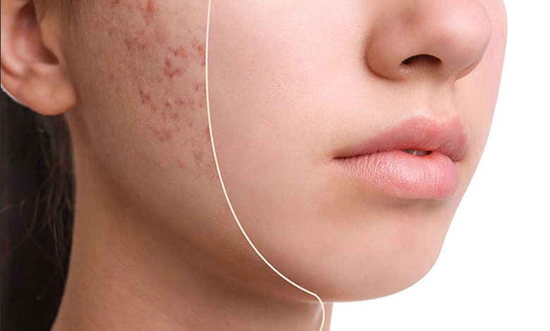 از بین بردن جوش صورت در یک روز