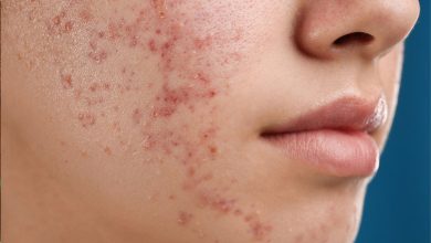 چه غذاهایی باعث جوش صورت میشود