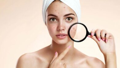 درمان سریع جوش صورت