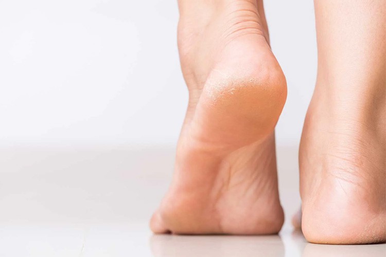 درمان خشکی پوست پا و کمک به بازسازی آن