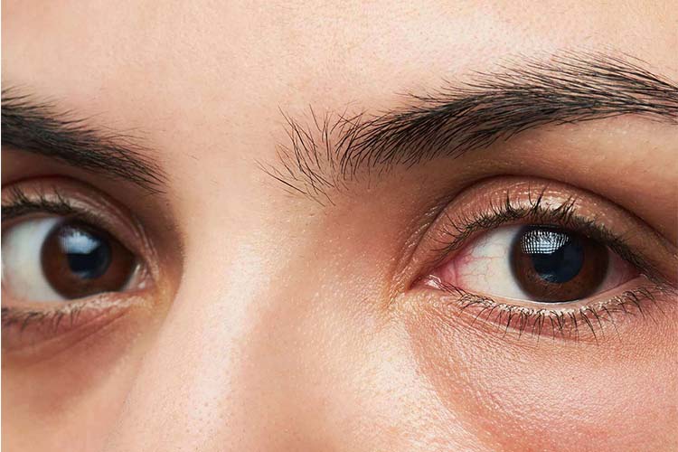 از بین بردن پف زیر چشم بدون عمل جراحی