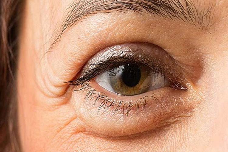 عوامل ایجاد کیسه زیر چشم و راه های از بین بردن آن