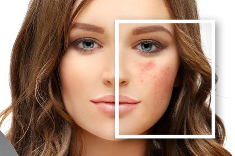 ترکیبات موجود در محصولات ضد جوش