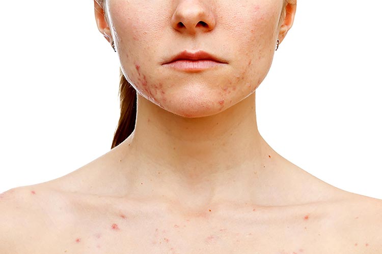 چرا جوش و آکنه خوب نمی شود؟