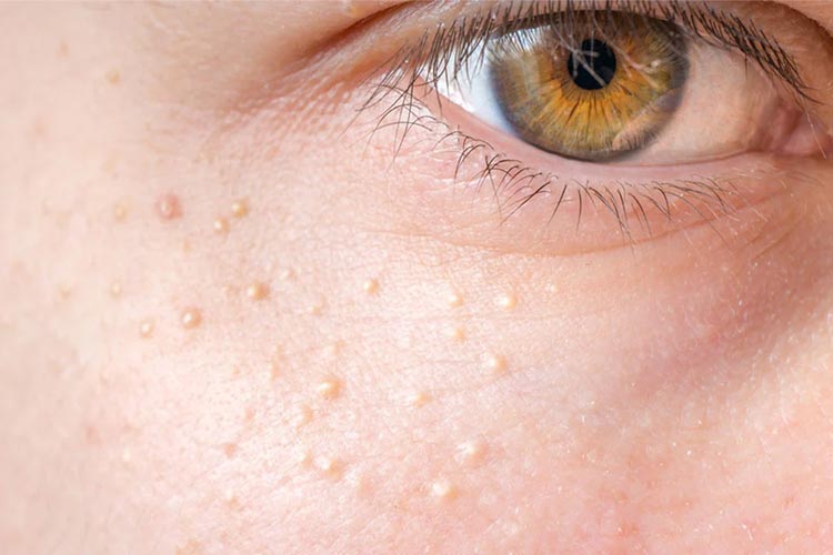 بهترین کرم دور چشم ضد میلیا