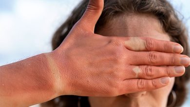 سفيد كردن پوست آفتاب سوخته