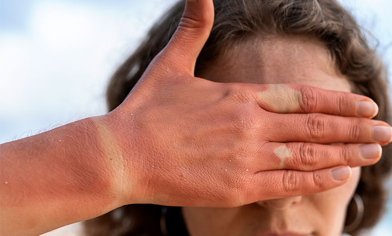 سفيد كردن پوست آفتاب سوخته