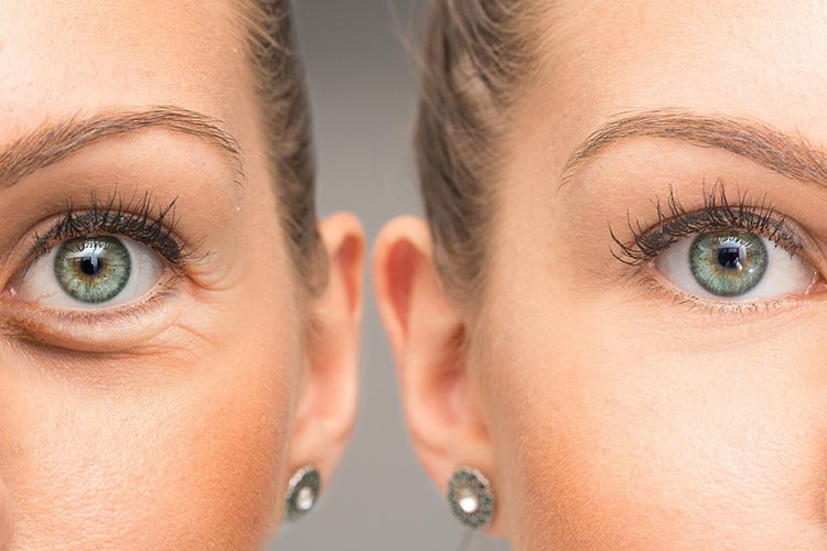 بهترین کرم رفع پف زیر چشم