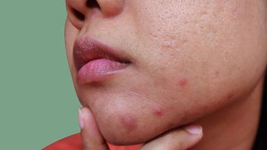 جوش چانه نشانه چیست