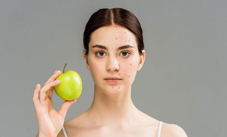 رژیم غذایی ضد جوش برای درمان جوش صورت