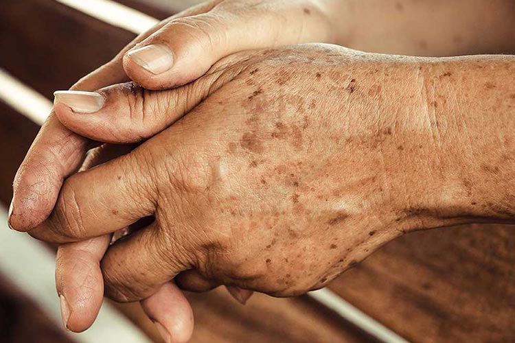 جلوگیری از لکه های پیری
