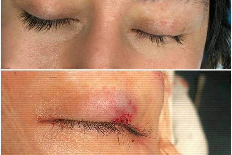 کاشت مژه دائم