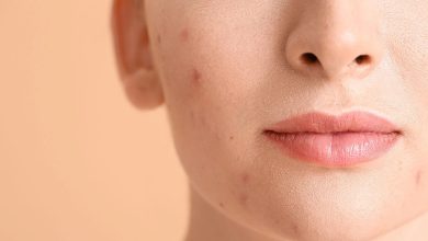 انواع کرم ضد لک