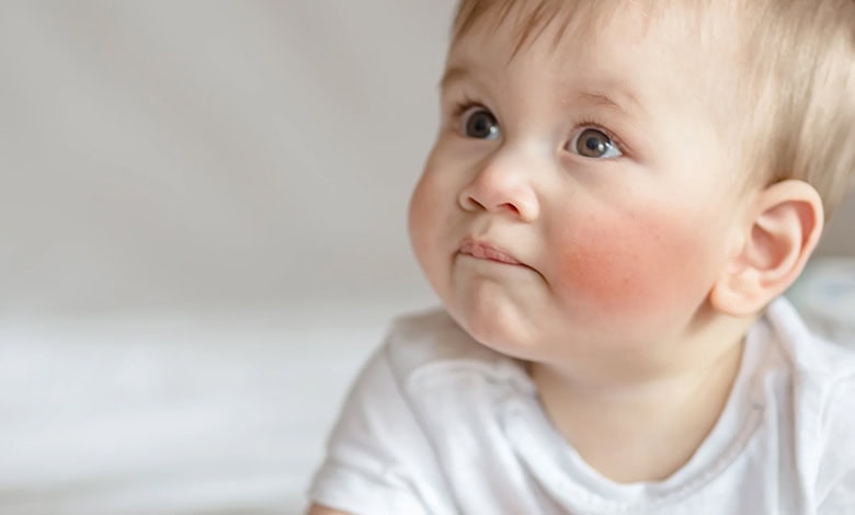 اگزما در کودکان و درمان آن