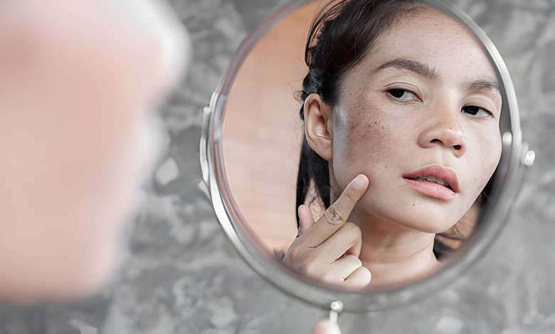 درمان خانگی پوسته پوسته شدن صورت