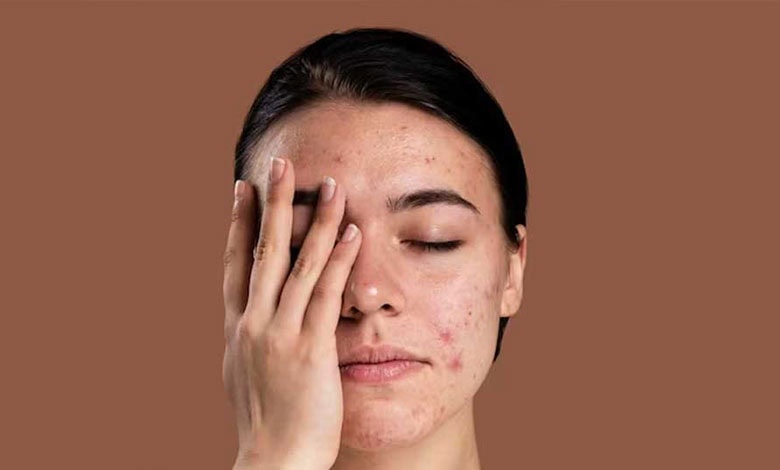 چرا جوش میزنیم