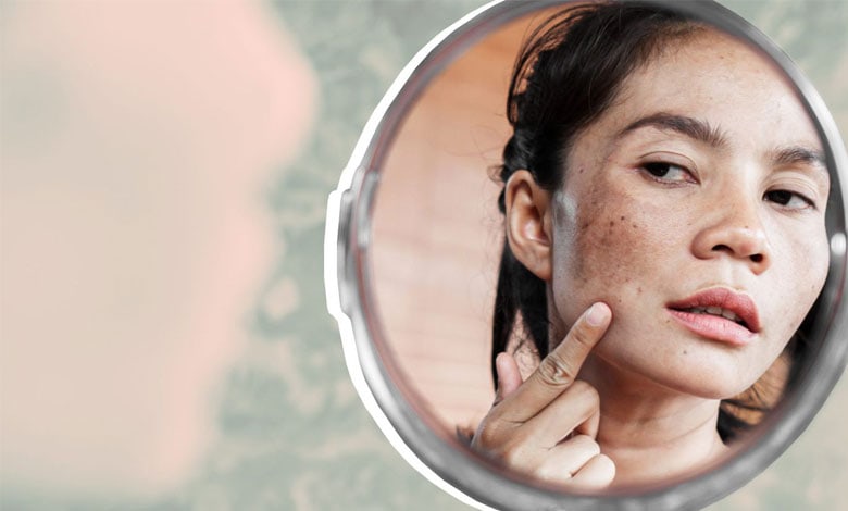 سریعترین راه از بین بردن لک قهوهای صورت