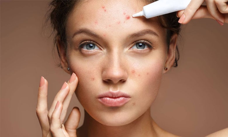 درمان جوش صورت