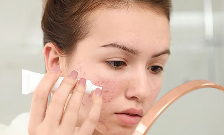 درمان جوش بلوغ