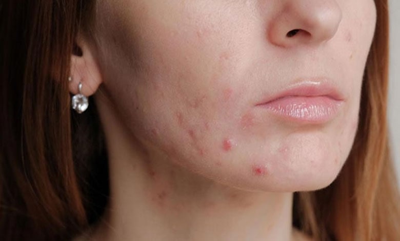 آکنه و جوش ناشی از شوره سر