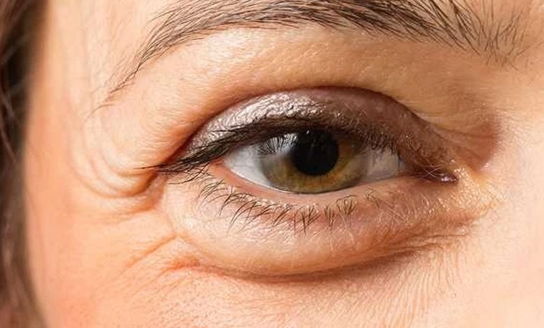 کمبود کدام ویتامین باعث پف زیر چشم میشود؟