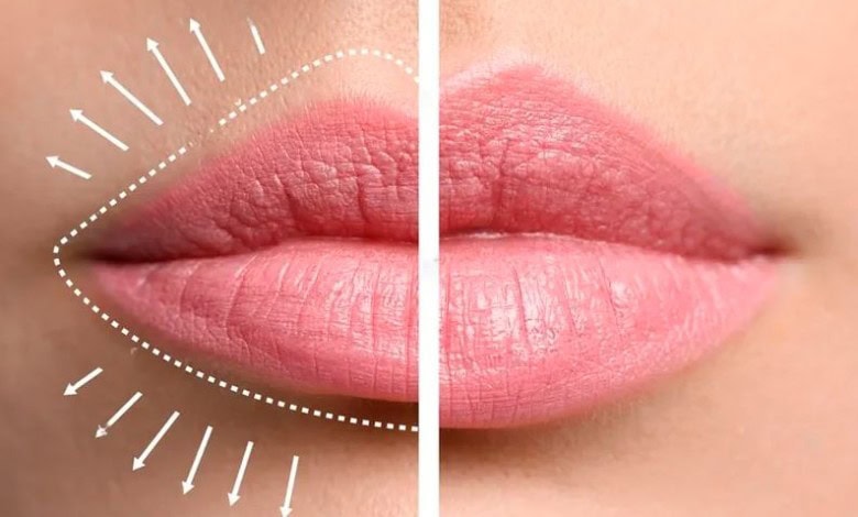 افزایش حجم لب