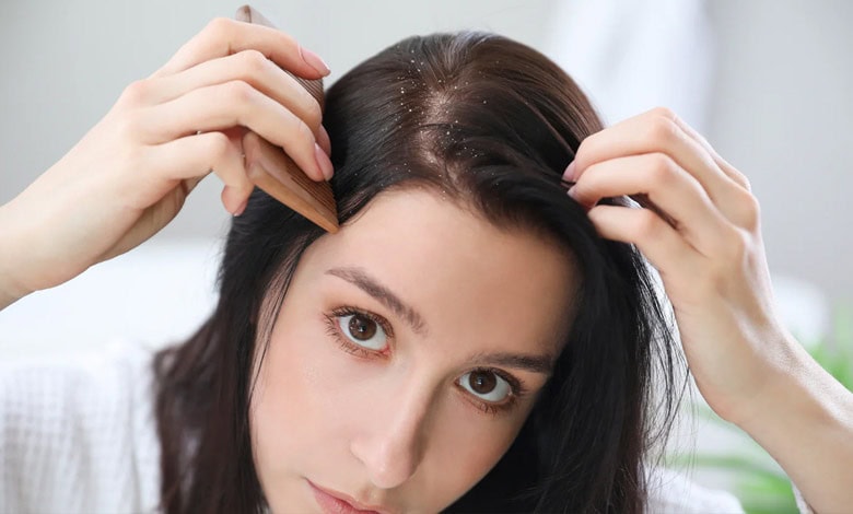 خارش به علت شوره سر