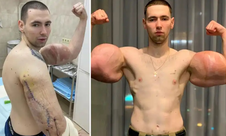 جراحی عضلات آسیب دیده با سینتول