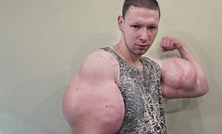 دفرمگی عضلات با سینتول