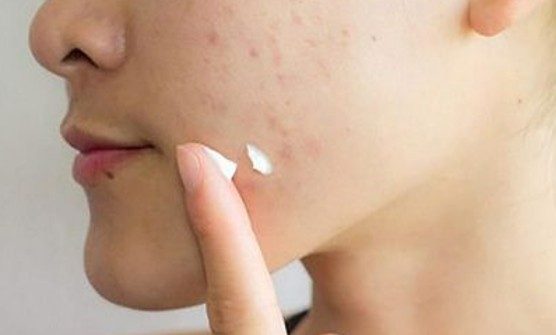 رفع جوش و آکنه با آلوورا 