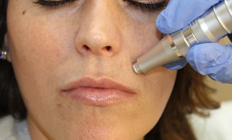 دستگاه جوانساز میکرونیدلینگ