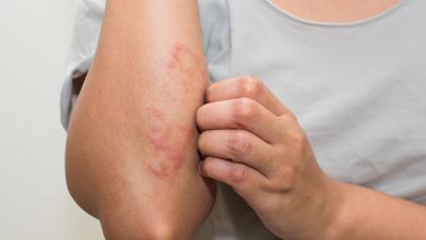 eczema-home-treatment