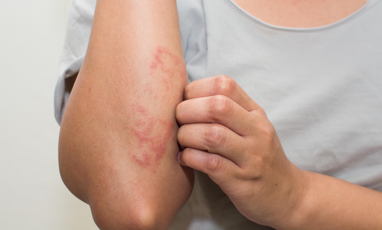 eczema-home-treatment