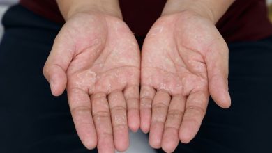 کمبود چه ویتامینی باعث پوسته شدن کف دست میشود?
