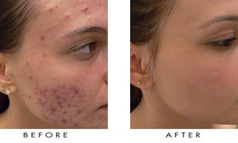  قبل و بعد از استفاده از راکوتان