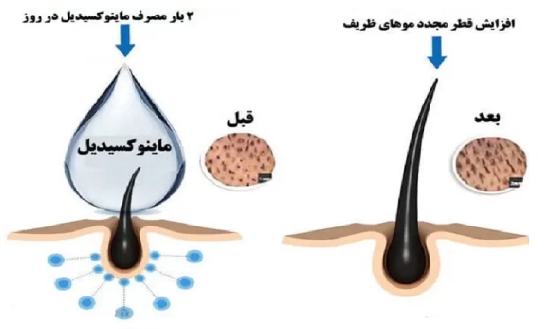 ماینوکسیدیل چیست؟ تفاوت ۲٪ و ۵٪، نحوه مصرف و عوارض
