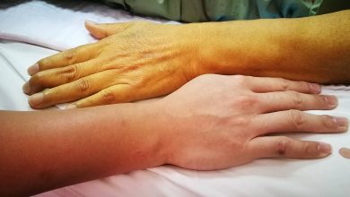 کمبود چه ویتامینی باعث زردی پوست میشود