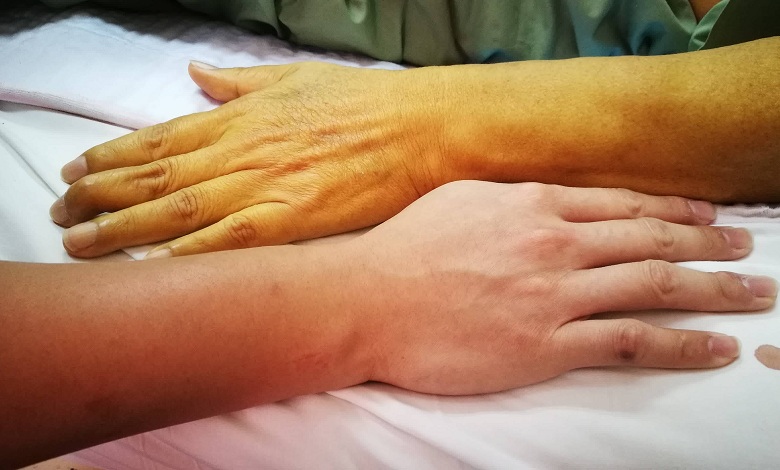 کمبود چه ویتامینی باعث زردی پوست میشود