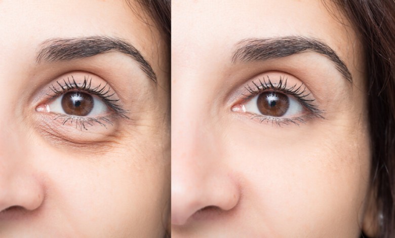 بهترین کرم برای سیاهی دور چشم؛ چطور سیاهی دور چشمها را از بین ببریم؟