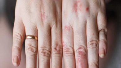 حساسیت به نقره؛ راهکارهای استفاده از نقره بدون بروز حساسیت