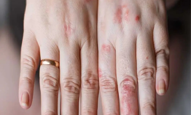 حساسیت به نقره؛ راهکارهای استفاده از نقره بدون بروز حساسیت