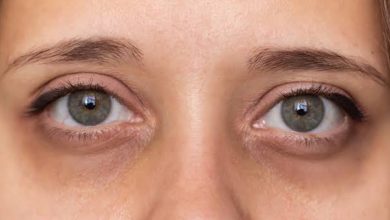 رفع تیرگی دور چشم در سه روز