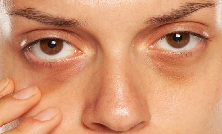 رفع تیرگی دور چشم در سه روز