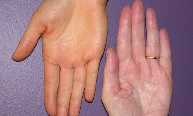 کمبود چه ویتامینی باعث زردی پوست میشود؟