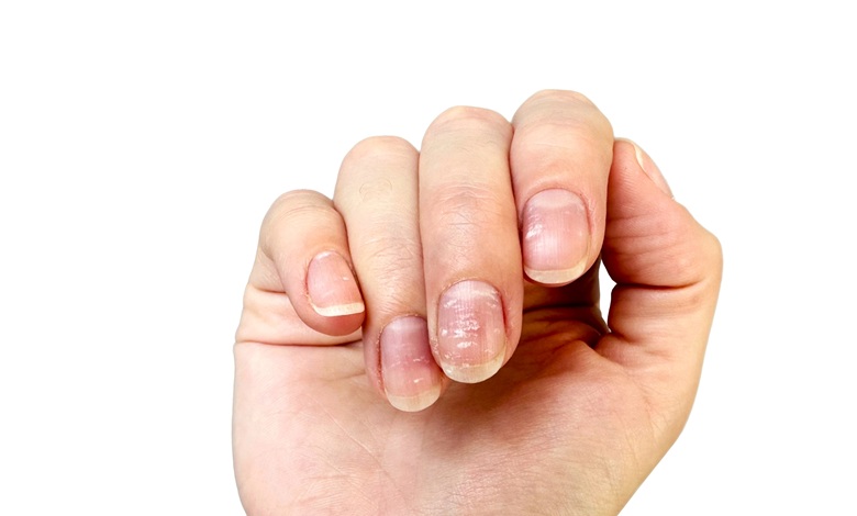 اصلی ترین علائم کمبود کلسیم چیست؟