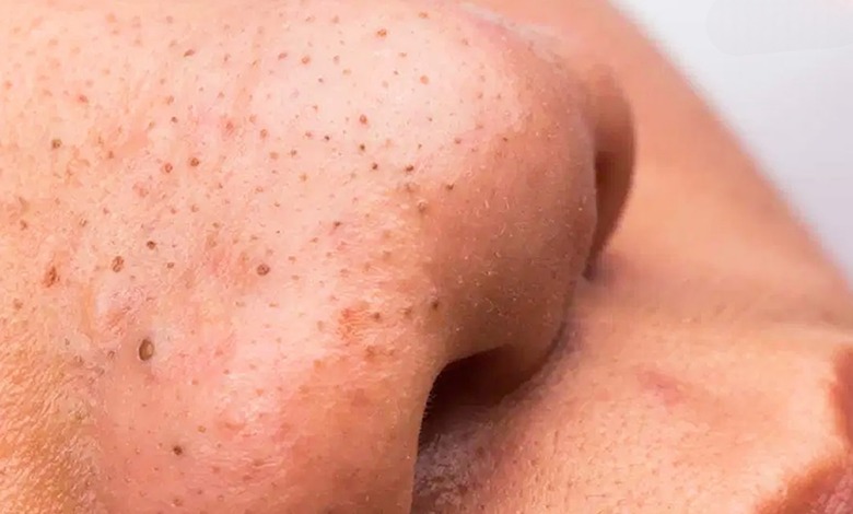 6 ماسک جوش سرسیاه خانگی که معجزه میکنند