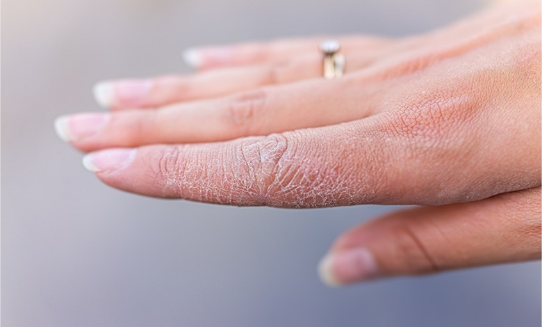 بهترین پماد برای خشکی پوست دست