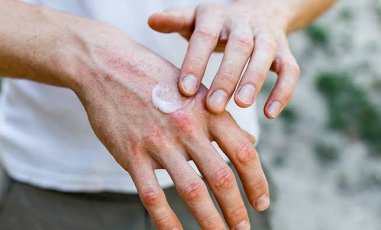 بهترین پماد برای خشکی پوست دست