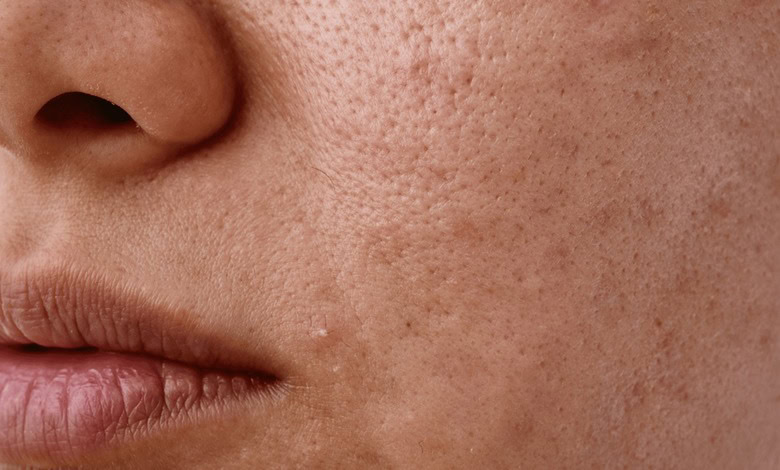 بهترین کرم برای جای جوش و لک صورت